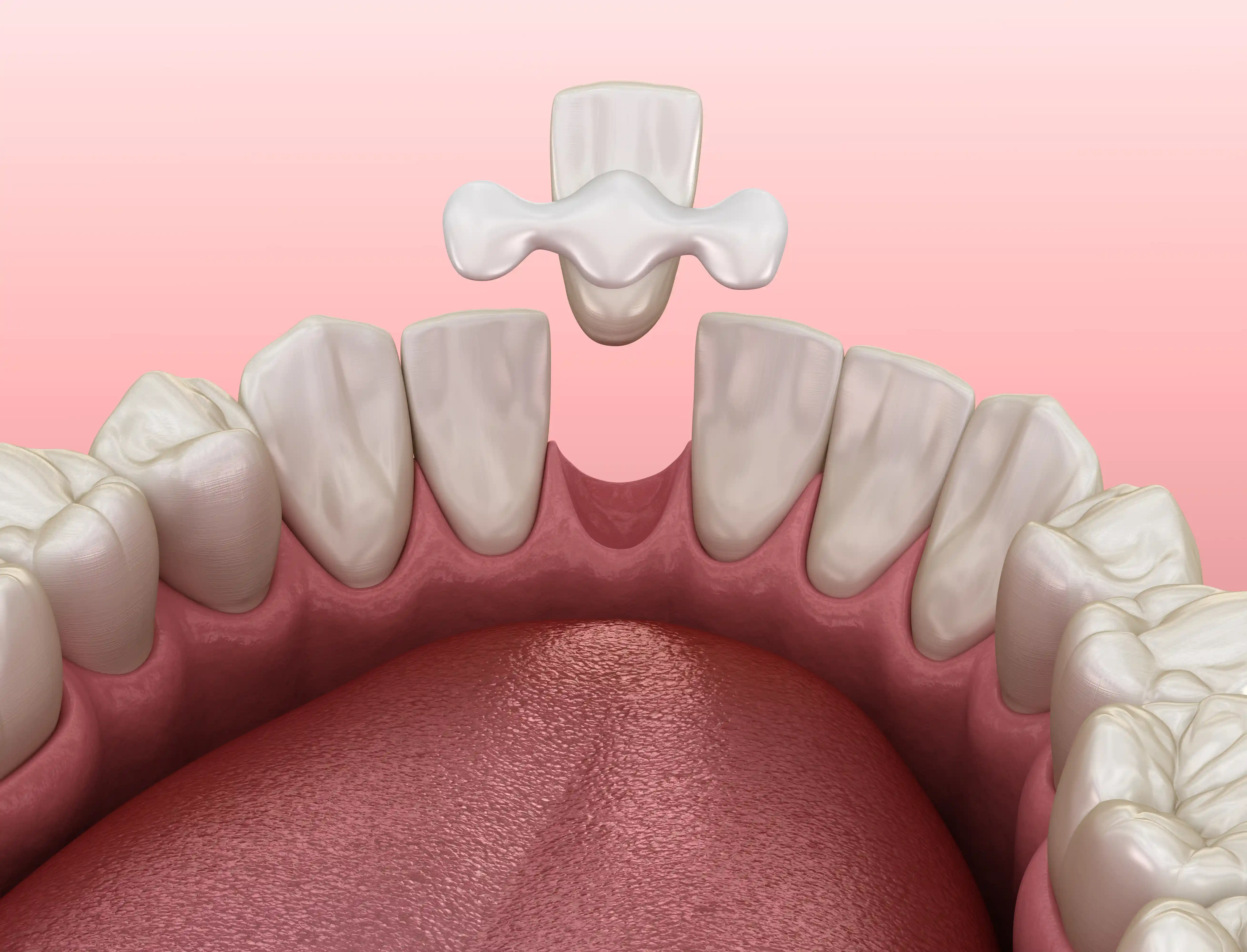 Resin bonded bridge example at South Kensington Medical and Dental