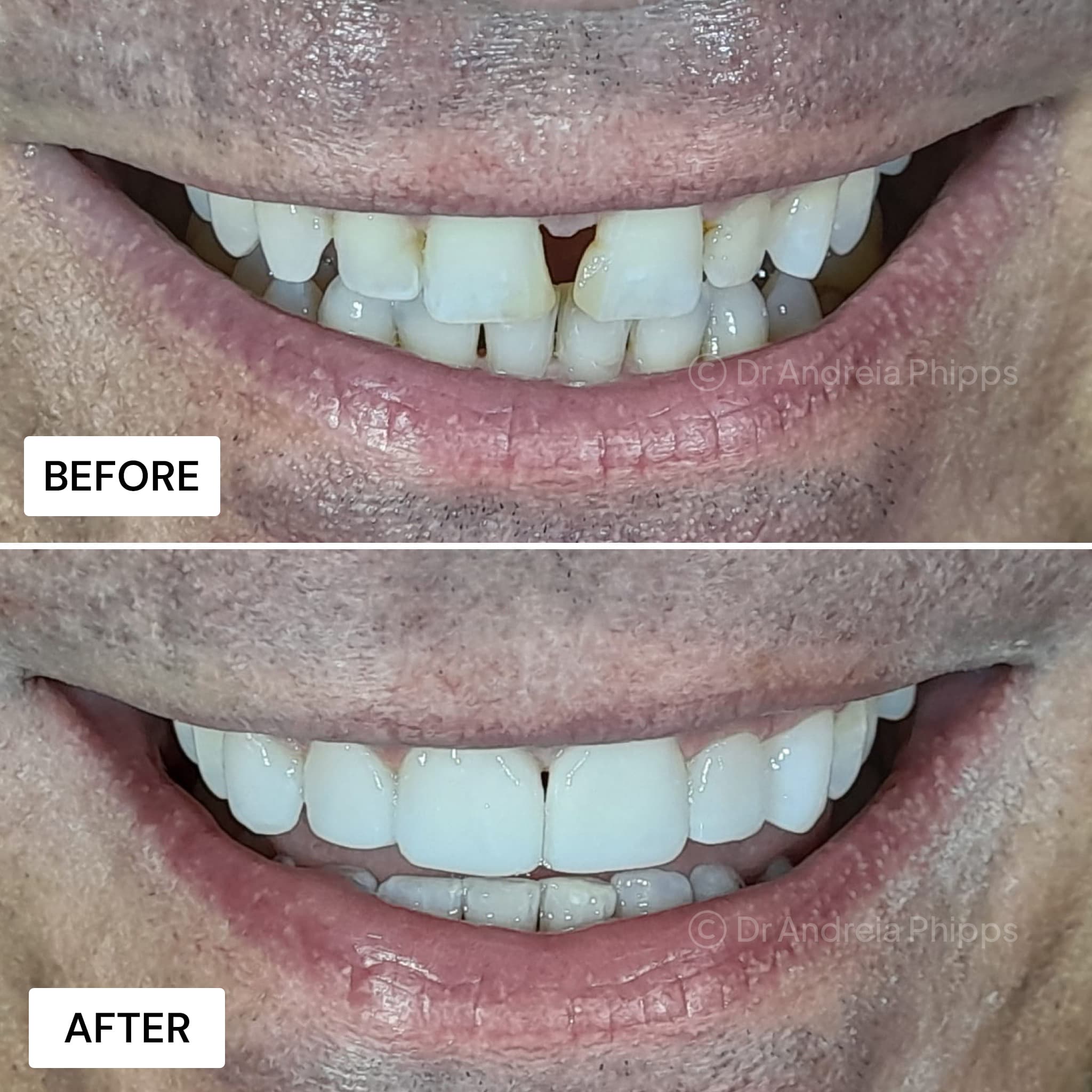 Smile transformation 2