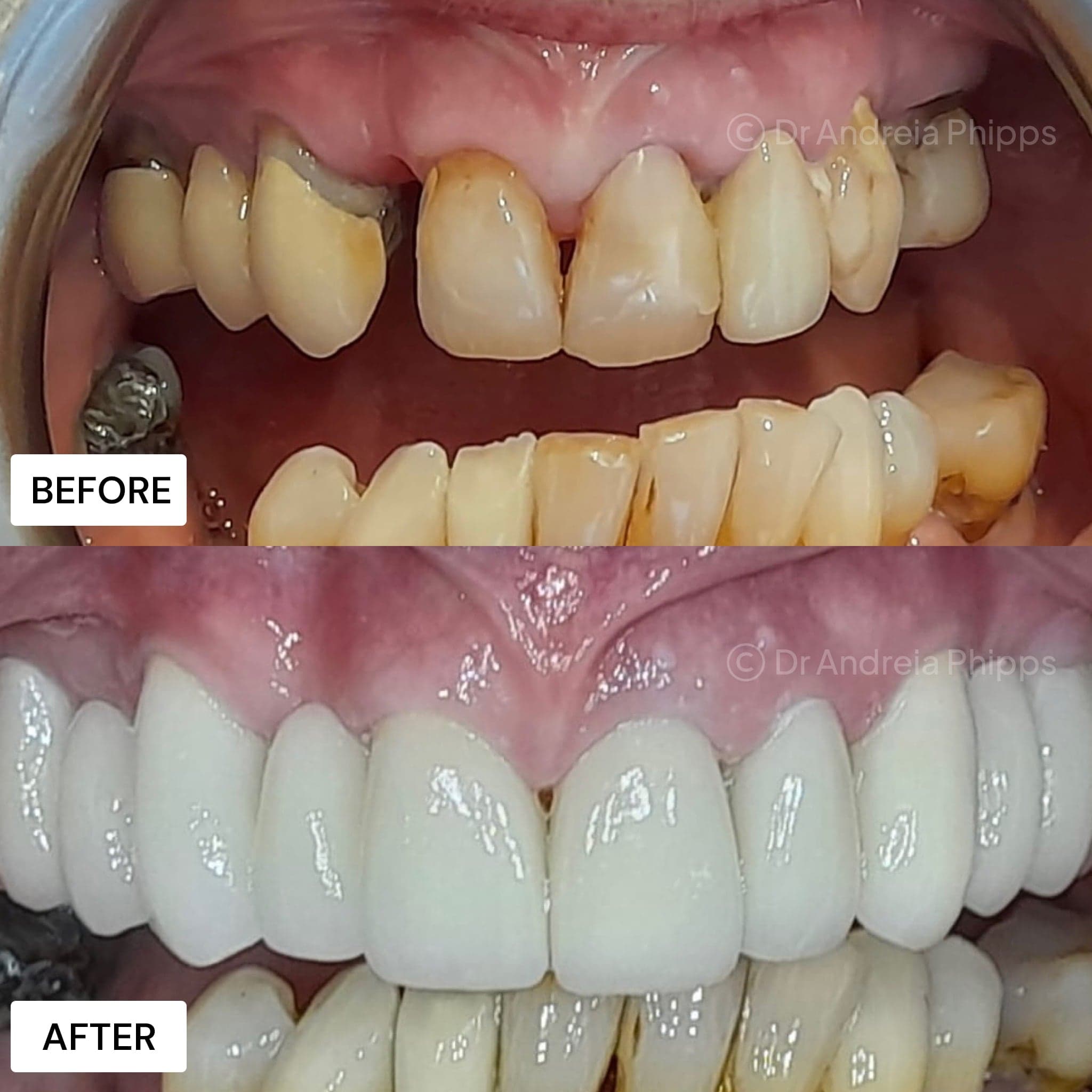 Smile transformation 15