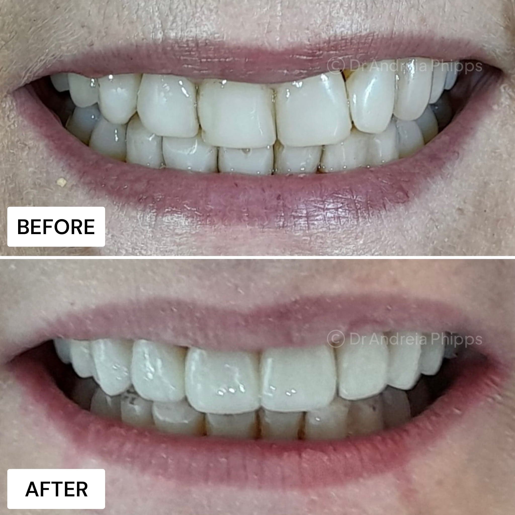 Smile transformation 16