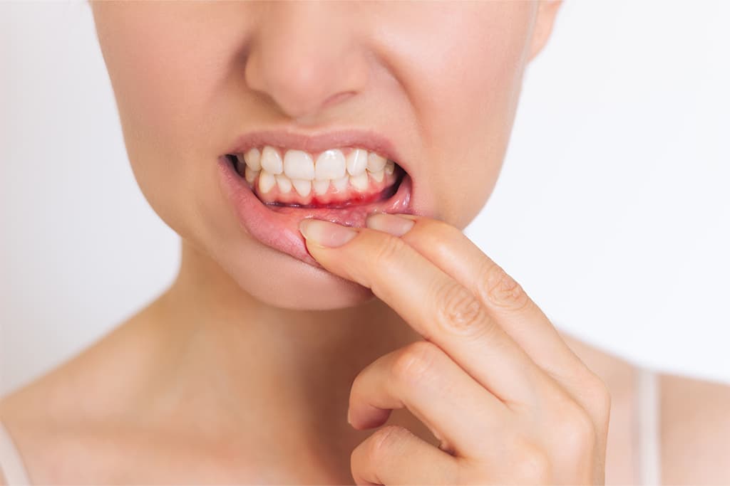 Why Your Gums Bleed After Brushing: Common Causes and When to See a Dentist