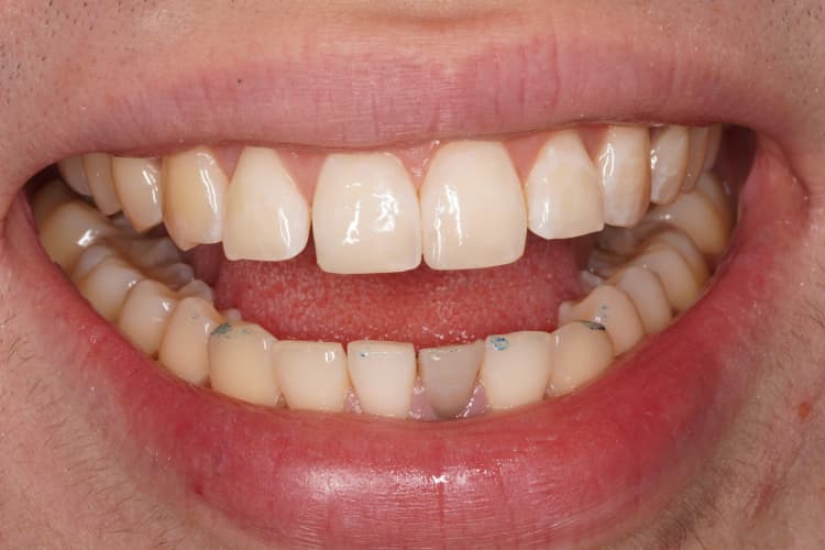 After composite bonding treatment