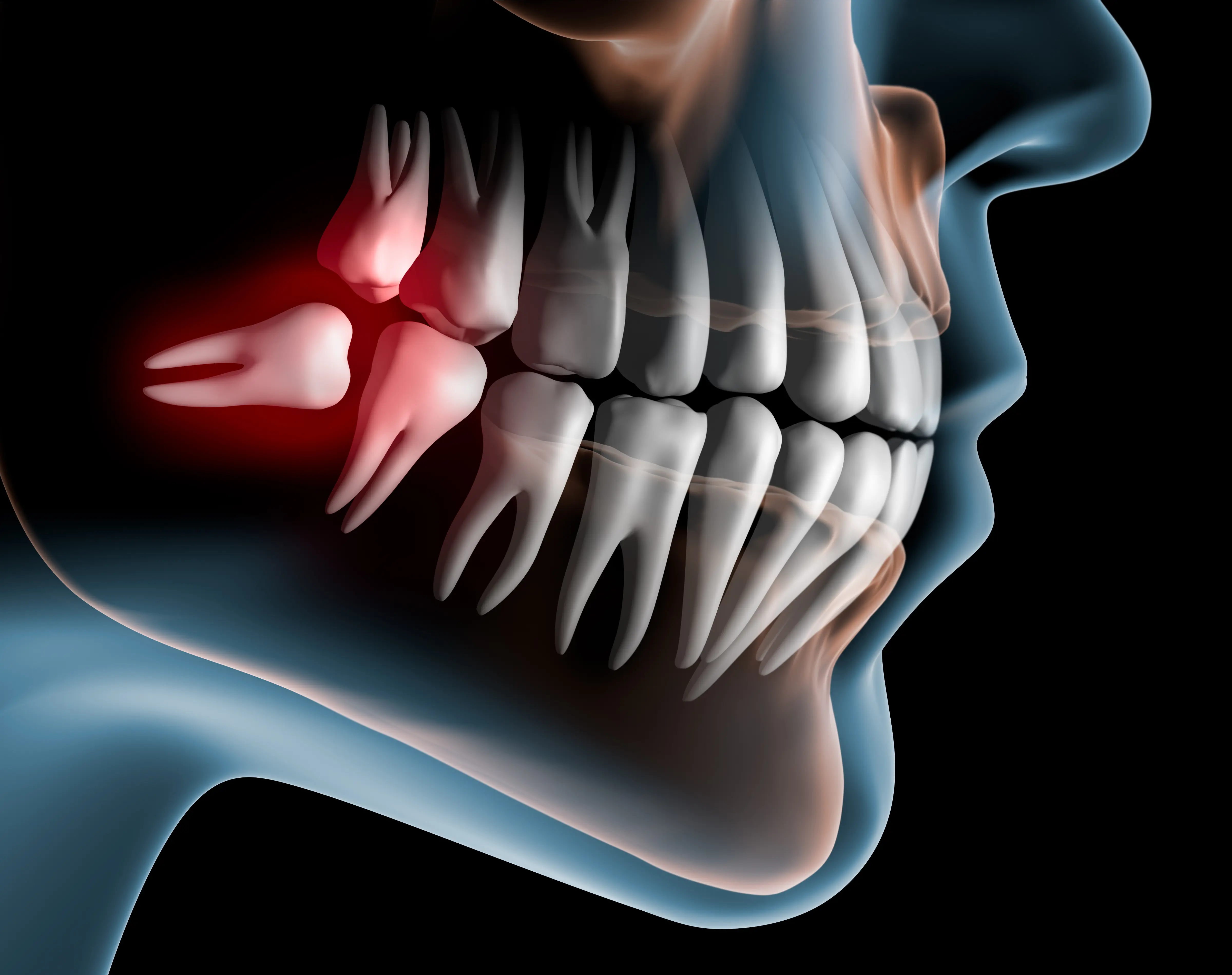 Wisdom Tooth Pain: How to Manage the Pain