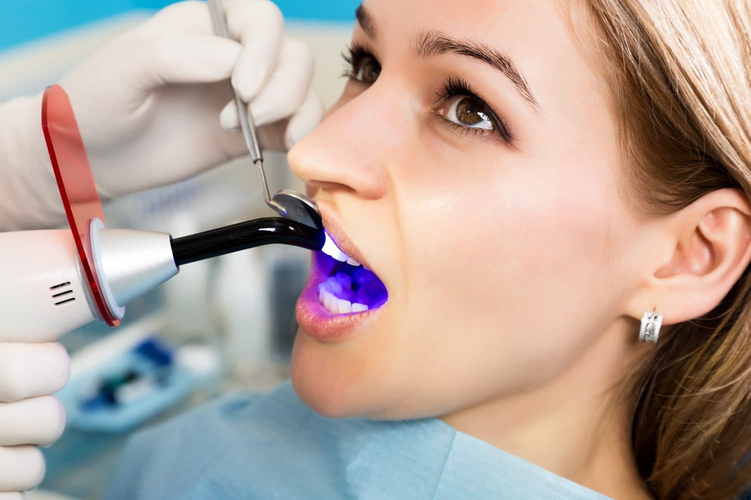 Can Teeth Decay Beneath Composite Bonding?