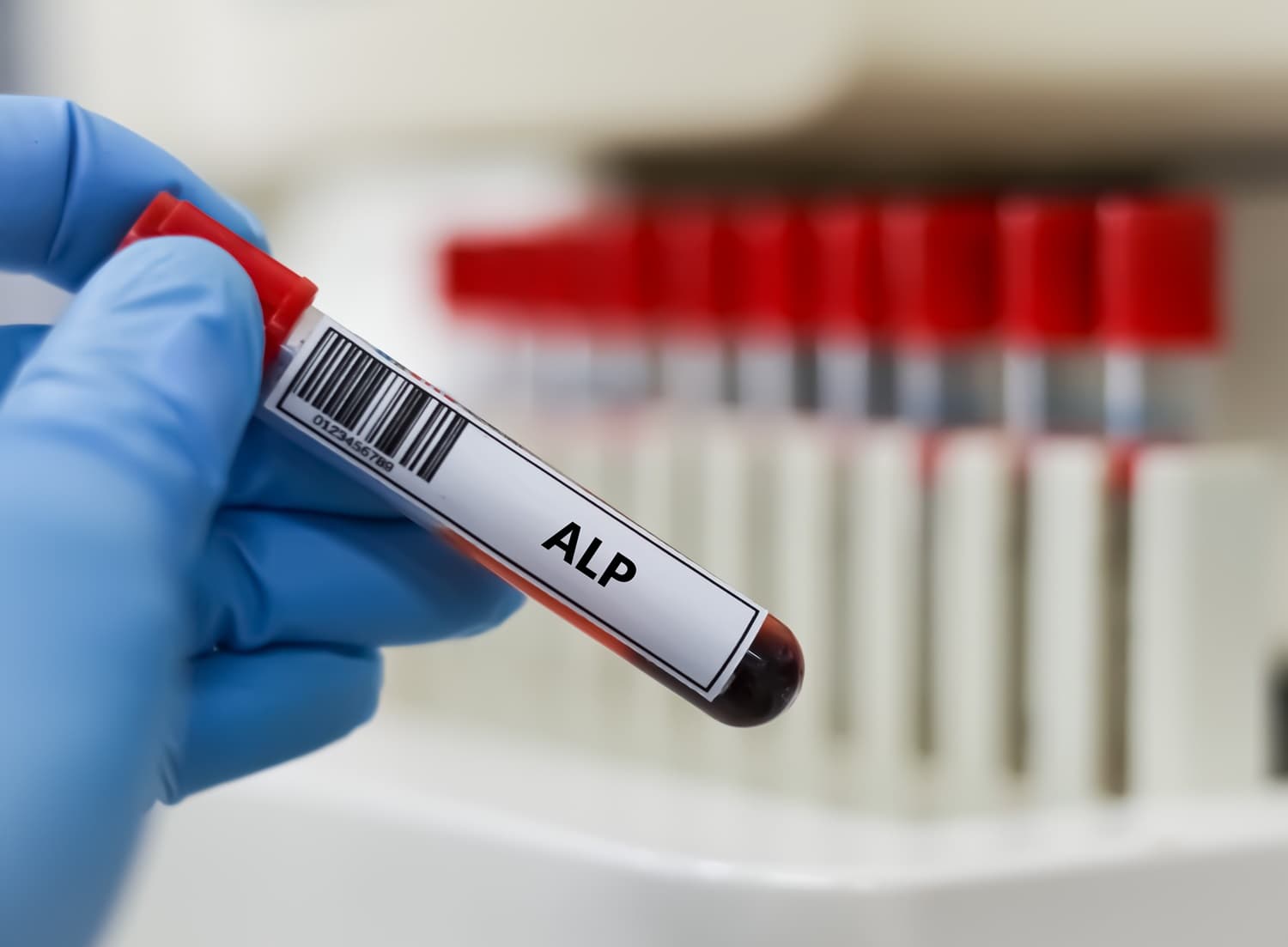 High Alkaline Phosphatase (ALP) in a Bone Profile Blood Test: Causes and What It Means
