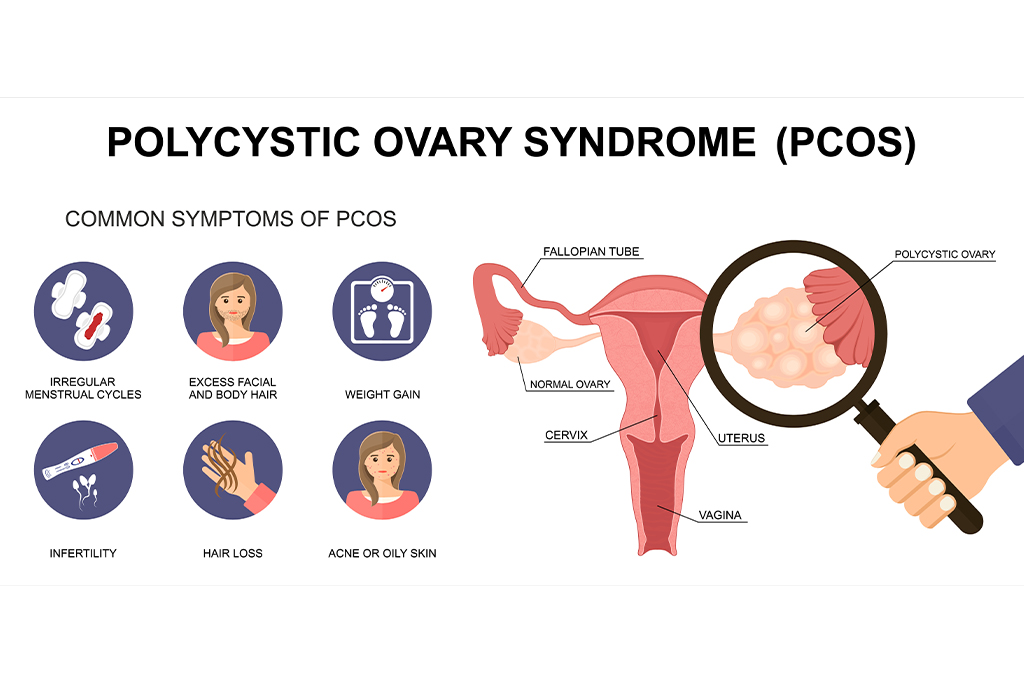 PCOS Symptoms: How to Recognise the Early Warning Signs