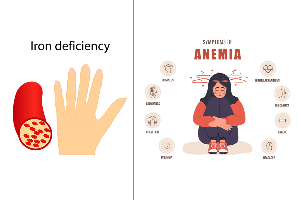 Iron Deficiency vs. Anaemia: Are they the same?