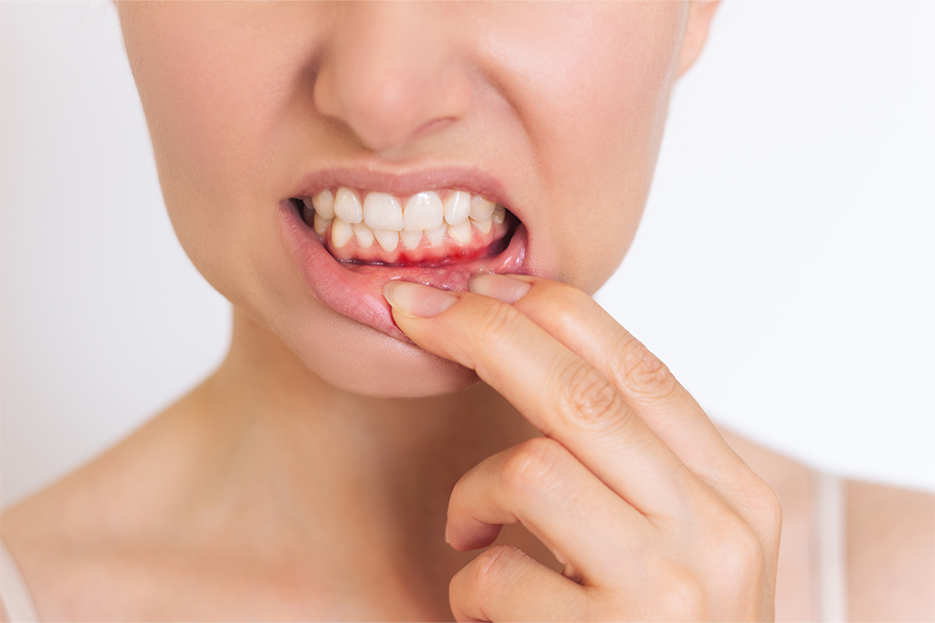 Why Your Gums Bleed After Brushing: Common Causes and When to See a Dentist